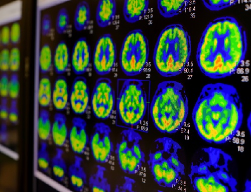 Imagen: Un nuevo biomarcador facilita la distinción entre Alzheimer y la tauopatía primaria (foto cortesía de Shutterstock)